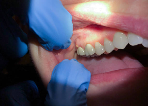 Best Emergency Treatment for Oral Infections in Cayuga Heights, NY